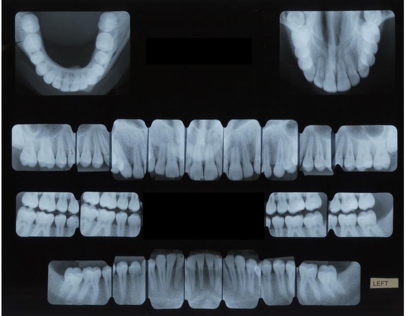 Full Mouth Series (FMX)