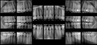 Full-mouth survey