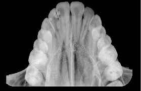 Occlusal Radiographs