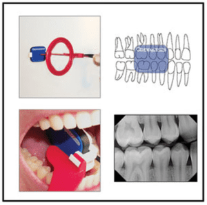 X-Ray holder placement for Bitewing is RED