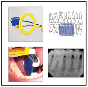 X-Ray holder placement for Posterior Periapical