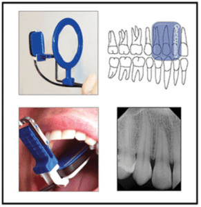 Anterior Periapical placement for x-ray holder (blue)